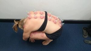 Cupping Therapy - Continuing Education Australia